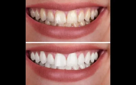 How to Achieve a Hollywood Smile with Teeth Whitening in Los Angeles