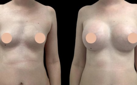 Top Results with Breast Augmentation Surgery in Dubai