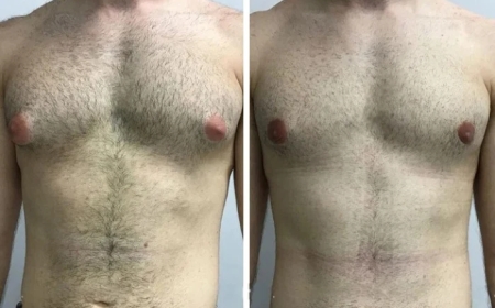Cost Breakdown: How Much Does Gynecomastia in Dubai Really Cost?