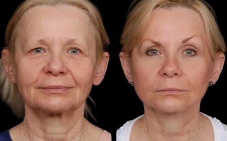 How Under Eye Fillers by the Best Doctors in Dubai Can Revitalize Your Eyes