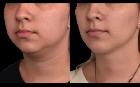 Understanding the Cost of Double Chin Removal Surgery with the Best Double Chin Removal Surgeon in Dubai