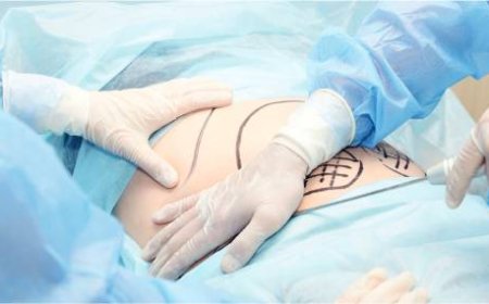 Tummy Tuck in Dubai: Flatten Your Abdomen with Trusted Surgical Techniques