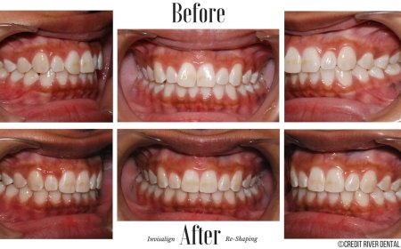 Mississauga Cheap and Affordable Clear Braces