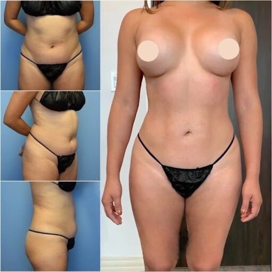 Best Doctors in Dubai for Body Contouring: Transforming Your Shape with Precision