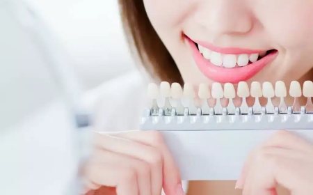 The Ultimate Guide to Veneers in Dubai: Transform Your Smile