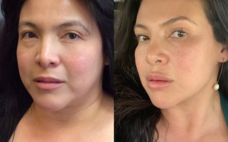 Achieving the Perfect Lip Lift: Insights from Newport Beach Patients