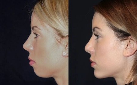 Chin Fillers in Dubai: How to Choose the Right Treatment Plan